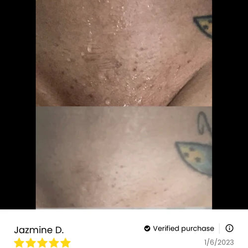 Radiant Muse Yoni Oil - For Dryness, Ingrown Hair, Dark Marks & Scars