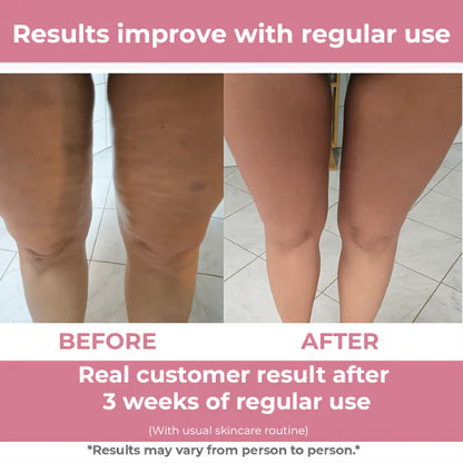 SilkSculpt™ - Cellulite & Skin Firming Device