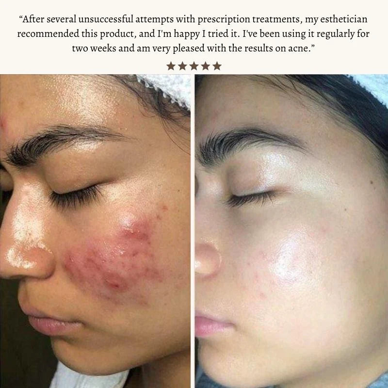 Radiant Pulse™ - High-Frequency Therapy Wand