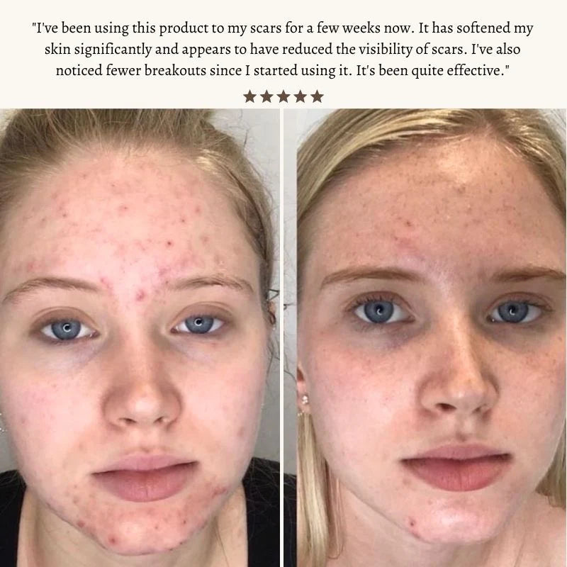 Radiant Pulse™ - High-Frequency Therapy Wand